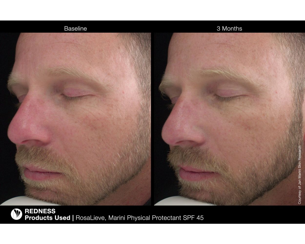 Rosalieve Redness Reducing Complex