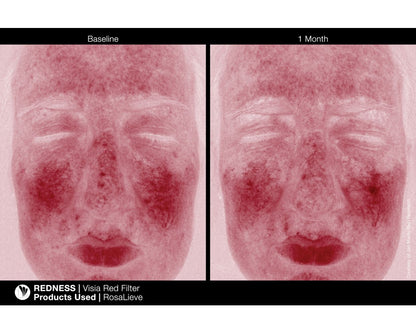 Rosalieve Redness Reducing Complex